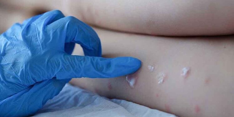 Monkeypox Virus is spreading in India too, know its symptoms and ways to avoid it