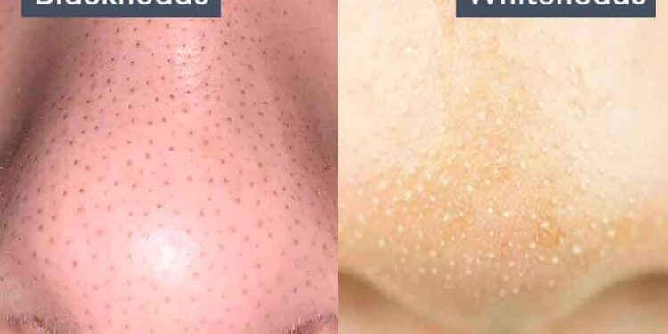 blackheads and whiteheads