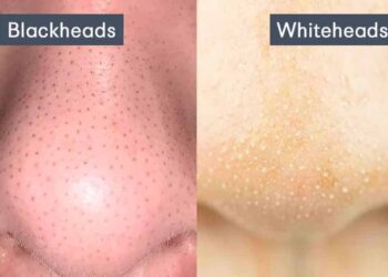 blackheads and whiteheads